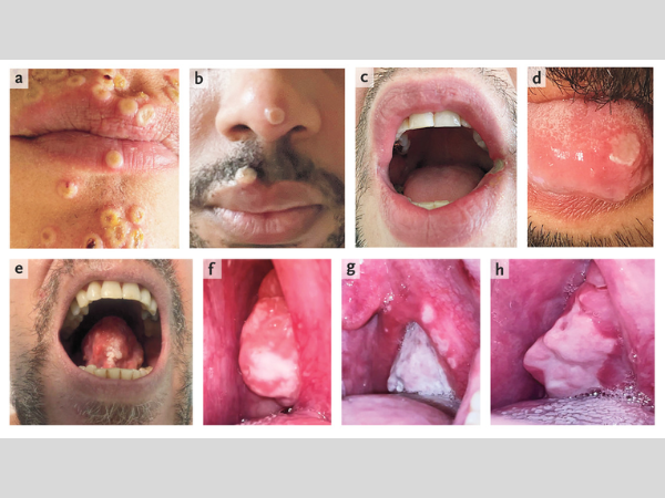 03-08-2022-Variola dos macacos-600x450