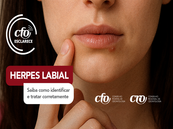 Herpes labial - 600 x 450